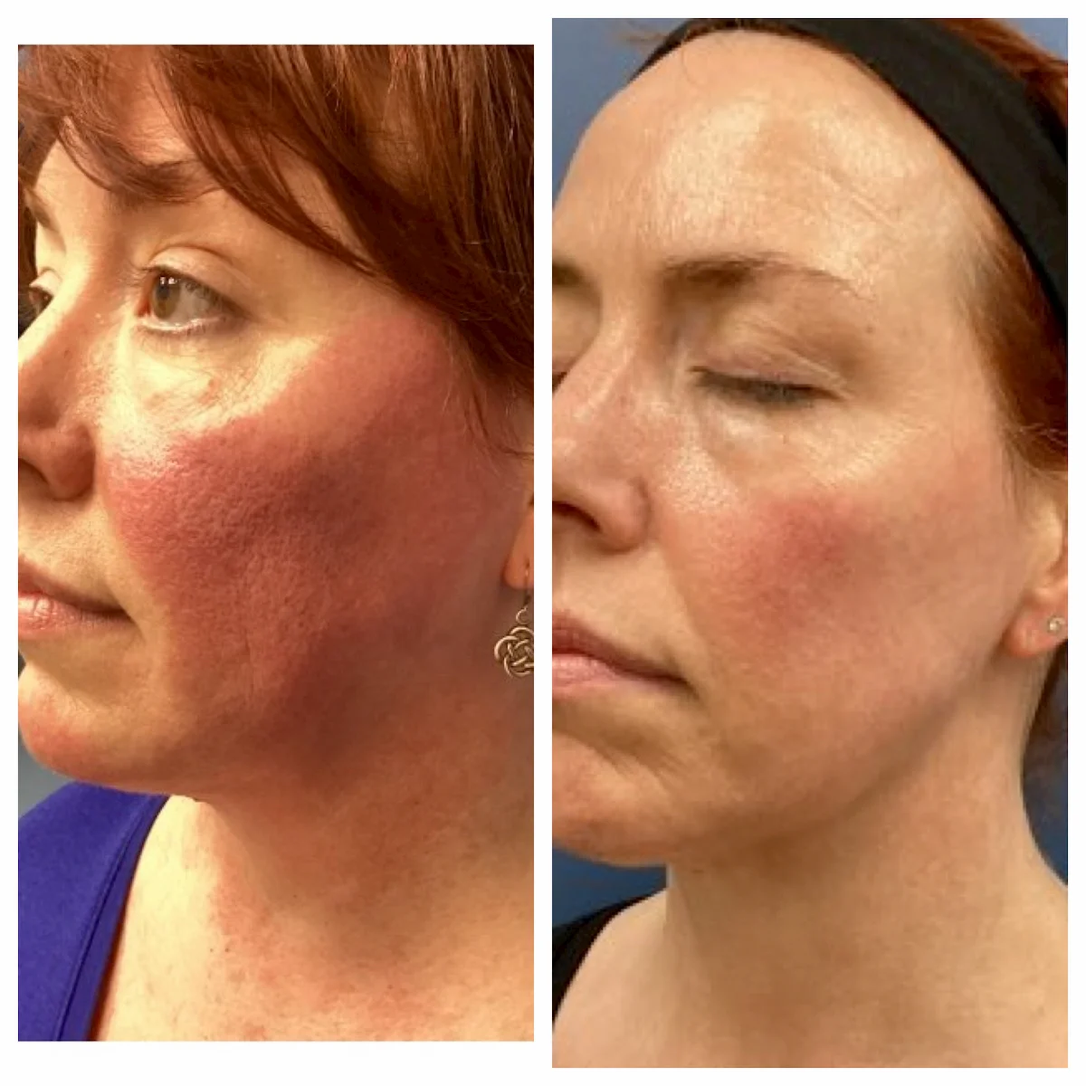 Severe facial redness from rosacea treated with IPL, before and after, side view — St. Louis Dermatology & Cosmetic Surgery