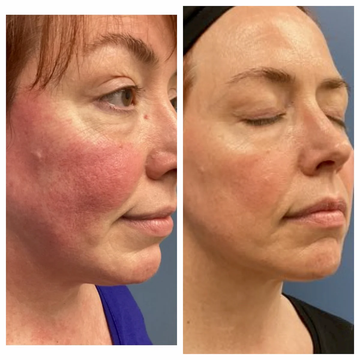 Severe facial redness from rosacea treated with IPL, before and after, oblique view — St. Louis Dermatology & Cosmetic Surgery
