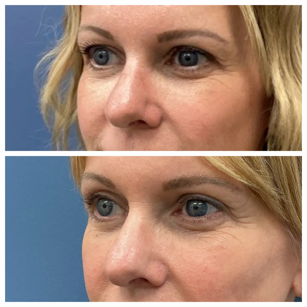 Eyelid surgery (blepharoplasty) before and after — St. Louis Dermatology & Cosmetic Surgery