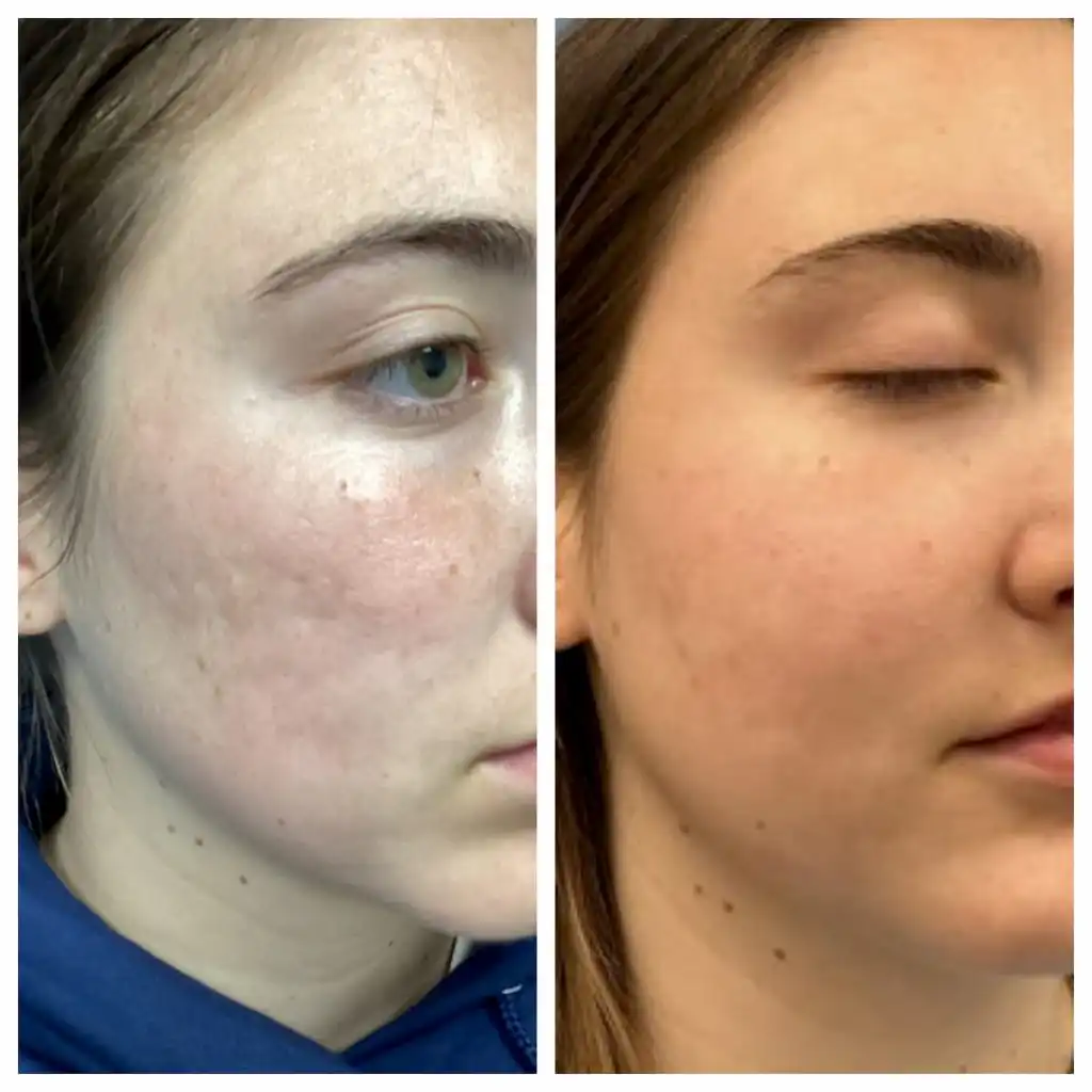 Acne scar treatment with subcision, filler, and laser before and after, second view — St. Louis Dermatology & Cosmetic Surgery