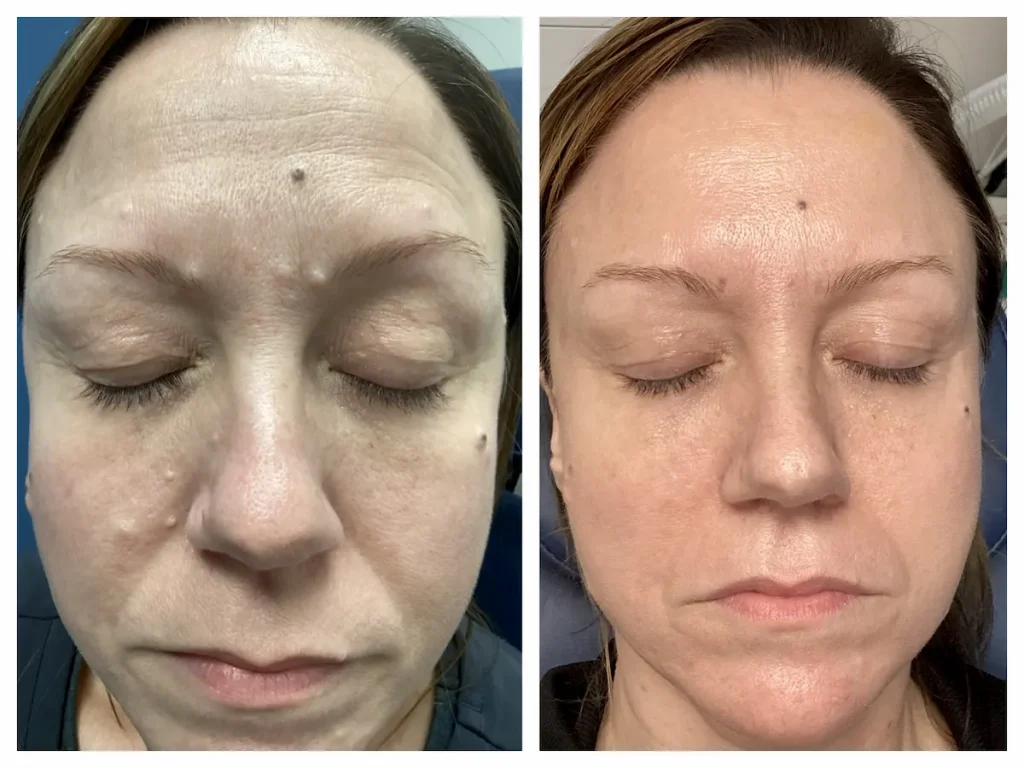 Best Facial Cosmetic Mole Removal