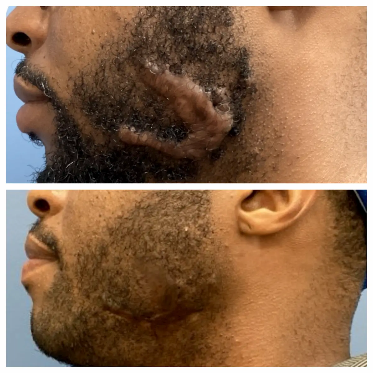 Cheek keloid treatment before and after, left view, patient of Dr. Brandon T. Beal