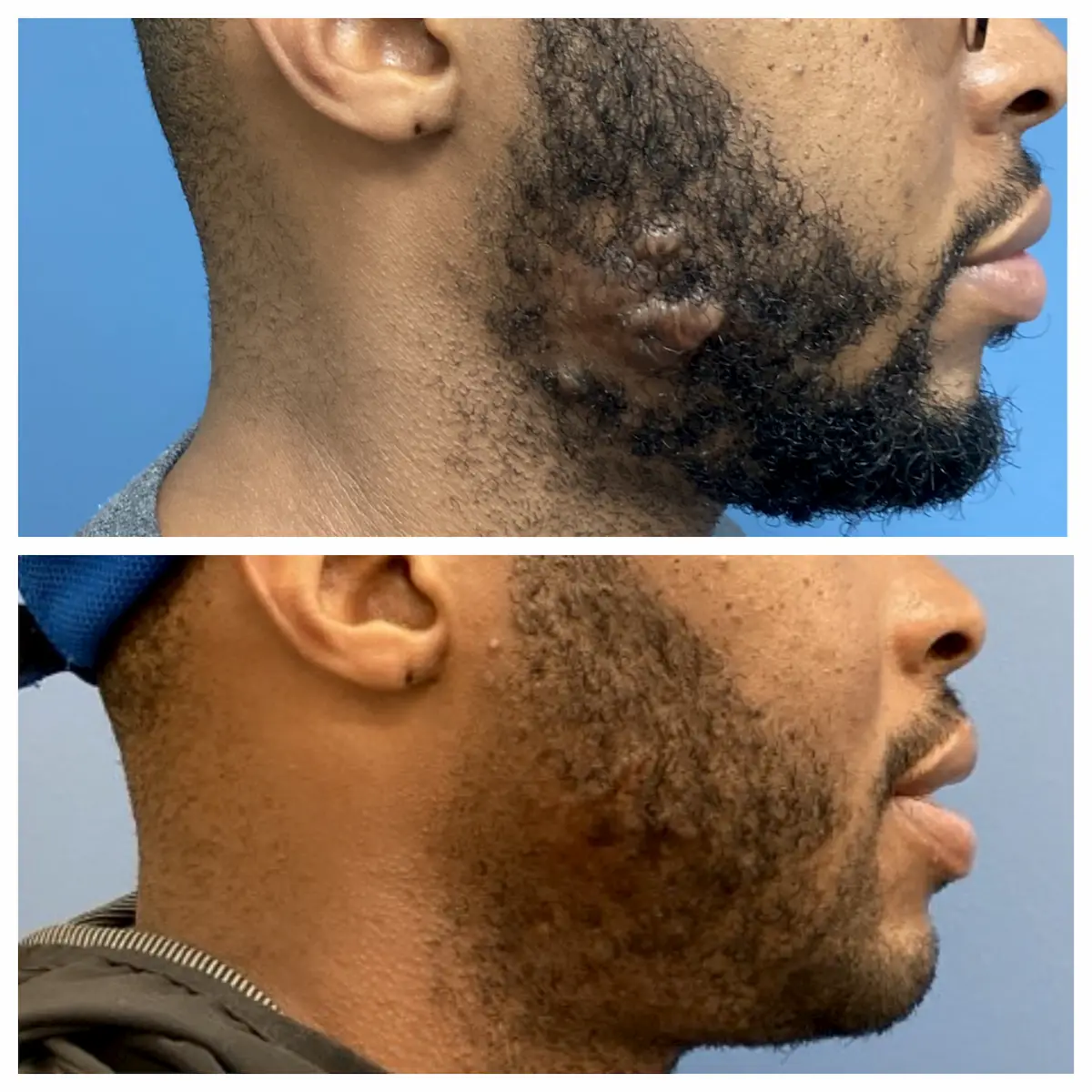 Cheek keloid treatment before and after, right view, patient of Dr. Brandon T. Beal