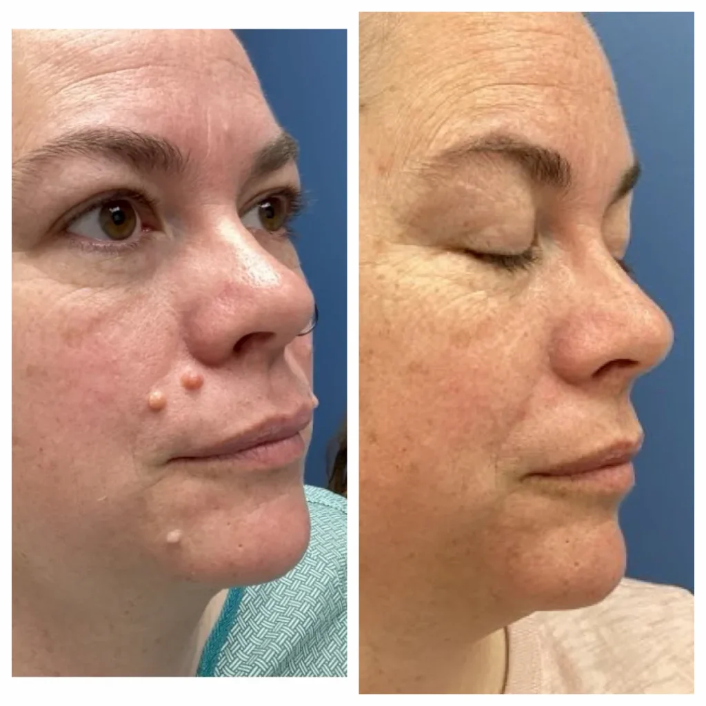 Cosmetic Mole Removal Face