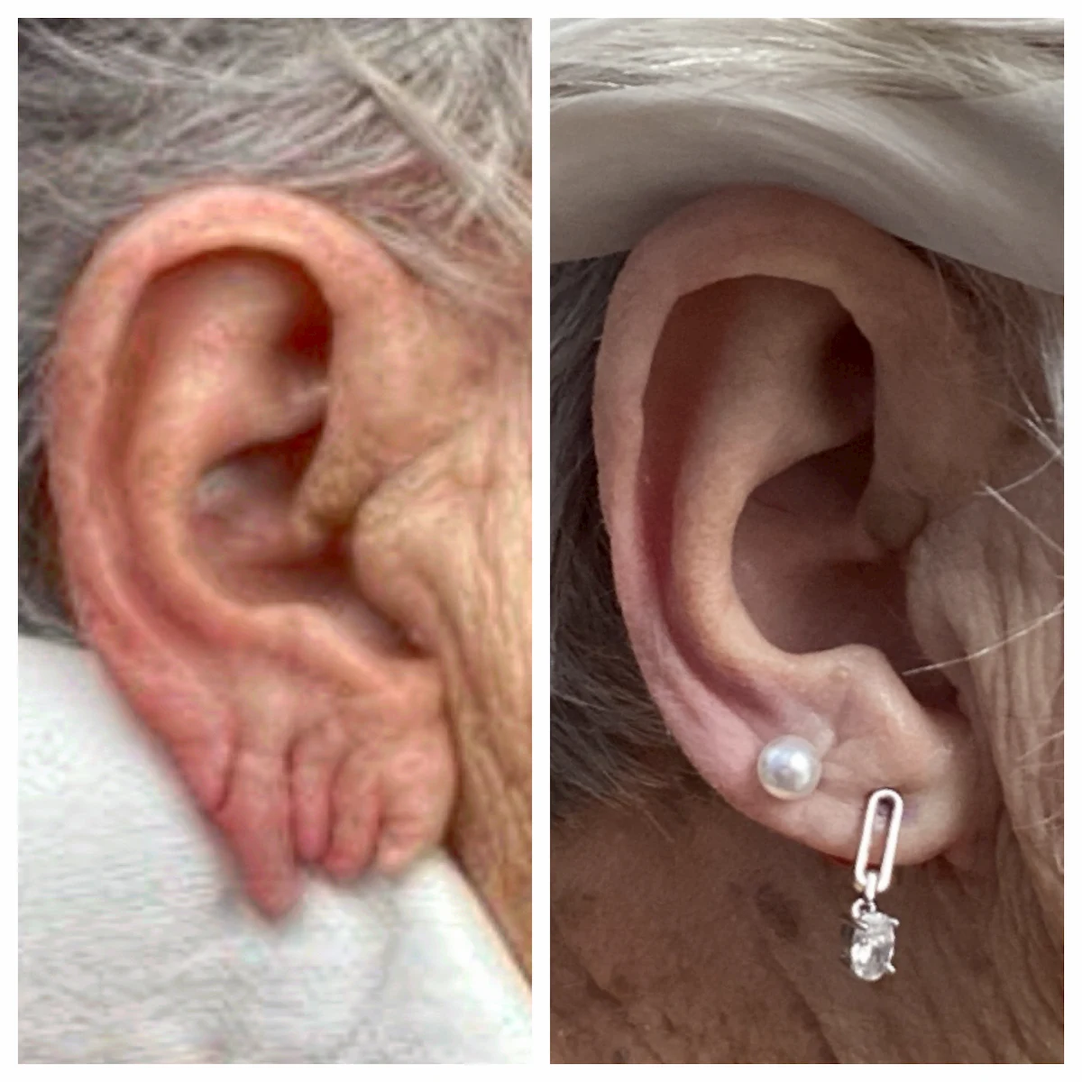 Stretched earlobe repair before and after — St. Louis Dermatology & Cosmetic Surgery