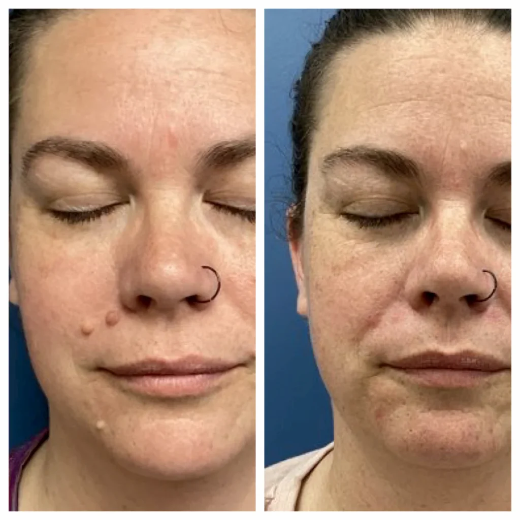 Facial Cosmetic Mole Removal Right Face