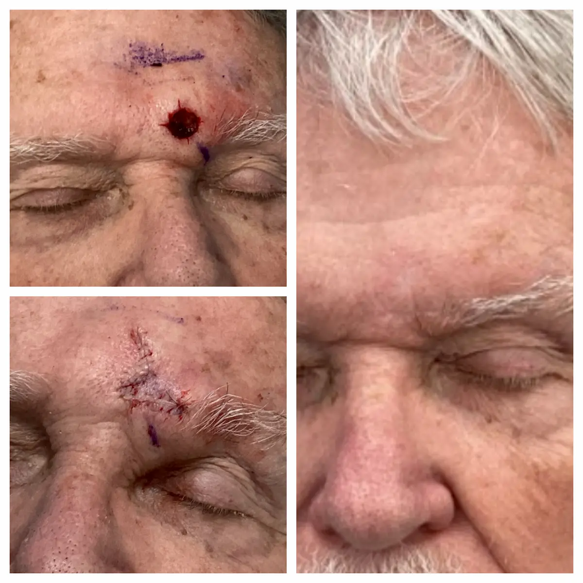 Forehead Mohs surgery and reconstruction, before and after — St. Louis Dermatology & Cosmetic Surgery