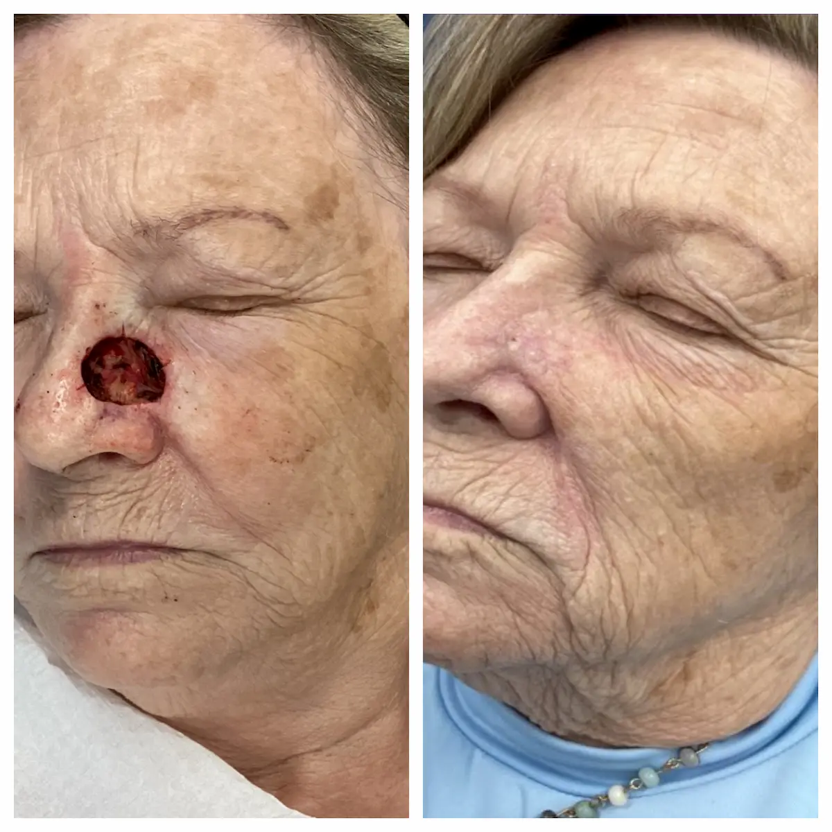 Nose Mohs surgery and reconstruction, before and after — St. Louis Dermatology & Cosmetic Surgery