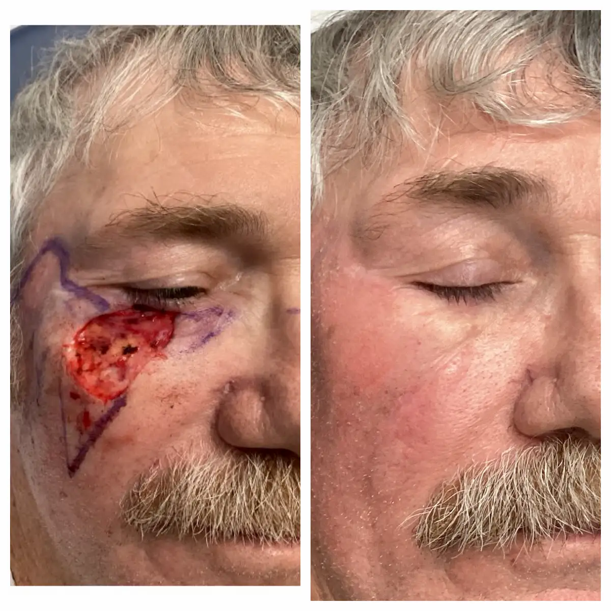 Lower eyelid skin cancer Mohs surgery and reconstruction, before and after — St. Louis Dermatology & Cosmetic Surgery