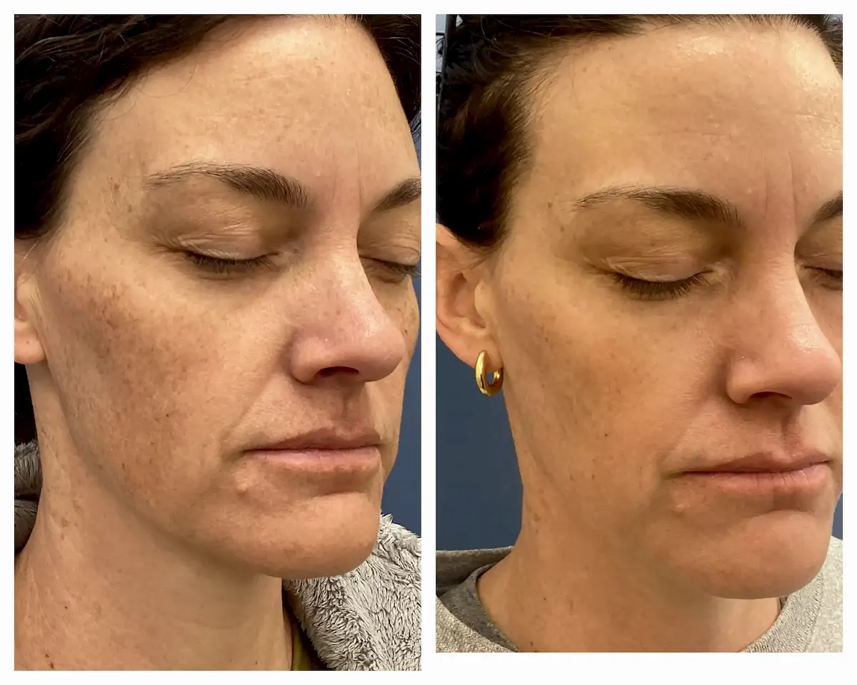 IPL for facial brown spots and sun damage before and after, opposite oblique view — St. Louis Dermatology & Cosmetic Surgery