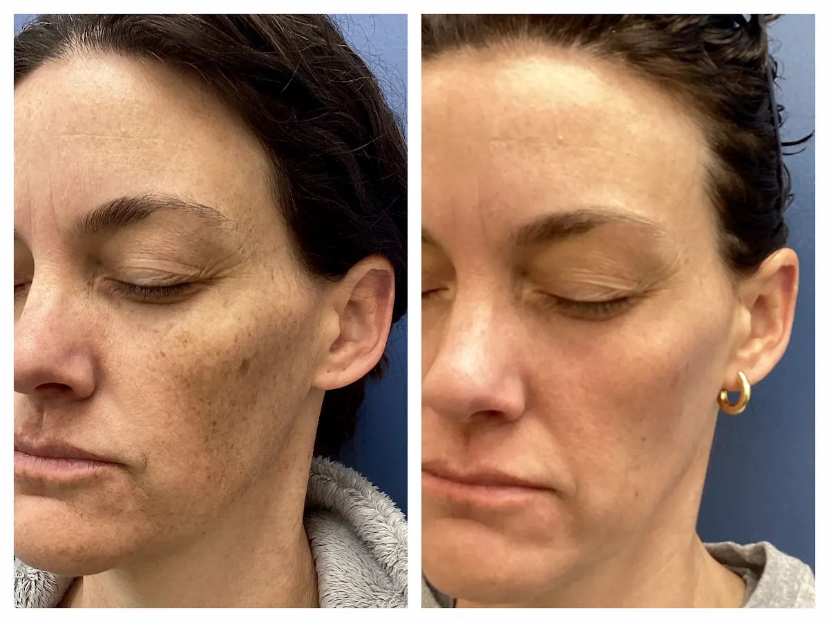 IPL for facial brown spots and sun damage before and after, oblique view — St. Louis Dermatology & Cosmetic Surgery