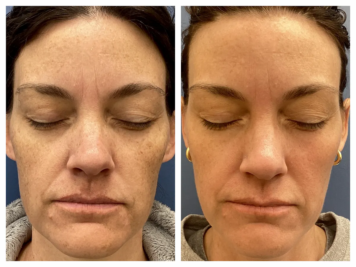 IPL for facial brown spots and sun damage before and after, front view — St. Louis Dermatology & Cosmetic Surgery
