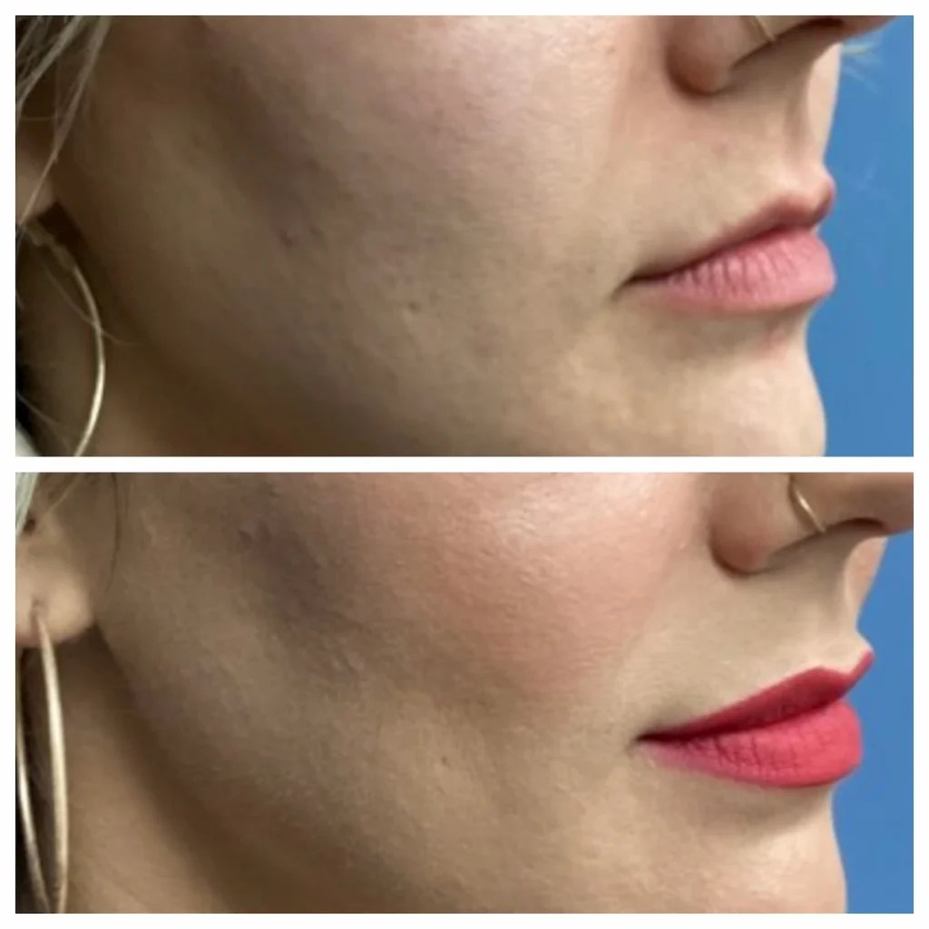 Lip Filler Best in STL