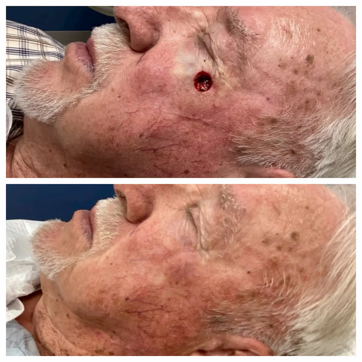 Left cheek Mohs surgery and reconstruction, before and after — St. Louis Dermatology & Cosmetic Surgery