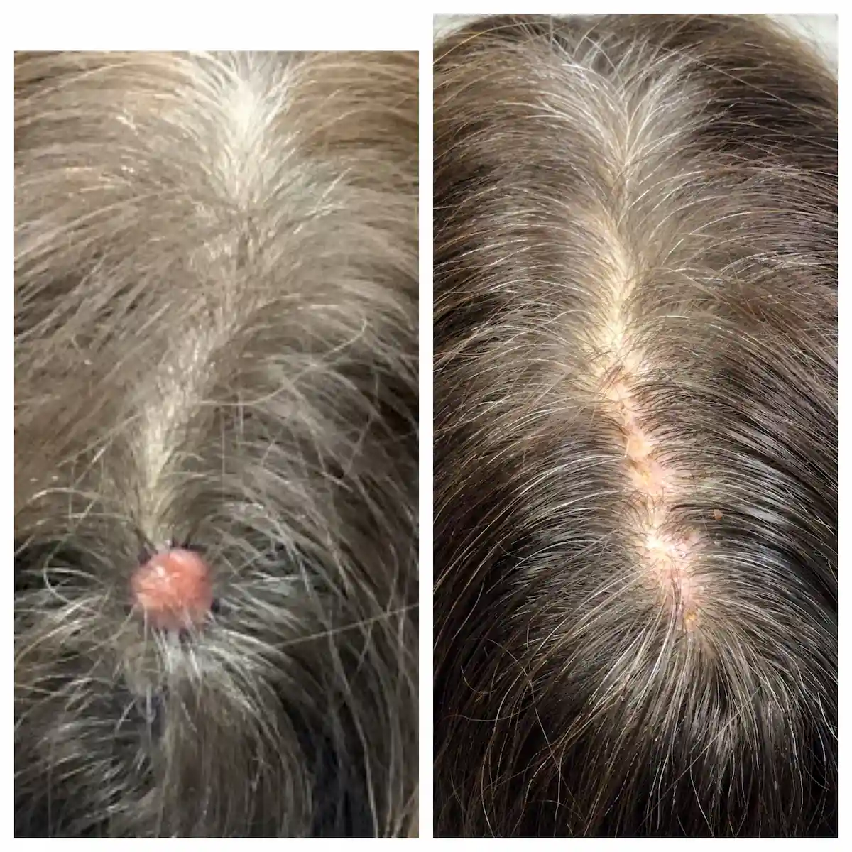 Scalp Mohs surgery and reconstruction, before and after — St. Louis Dermatology & Cosmetic Surgery