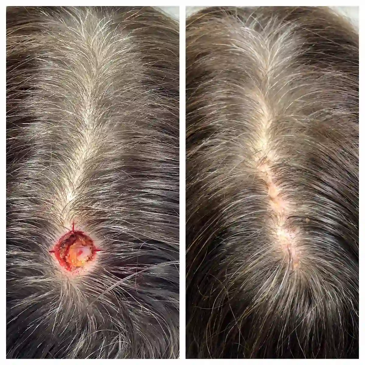 Scalp Mohs surgery and reconstruction, second view, before and after — St. Louis Dermatology & Cosmetic Surgery