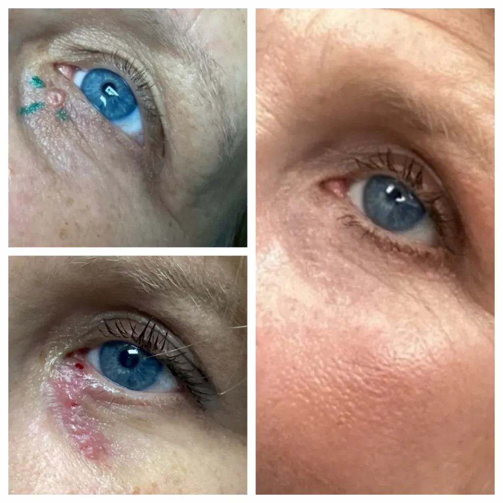 Mohs Surgery before and after lower eyelid