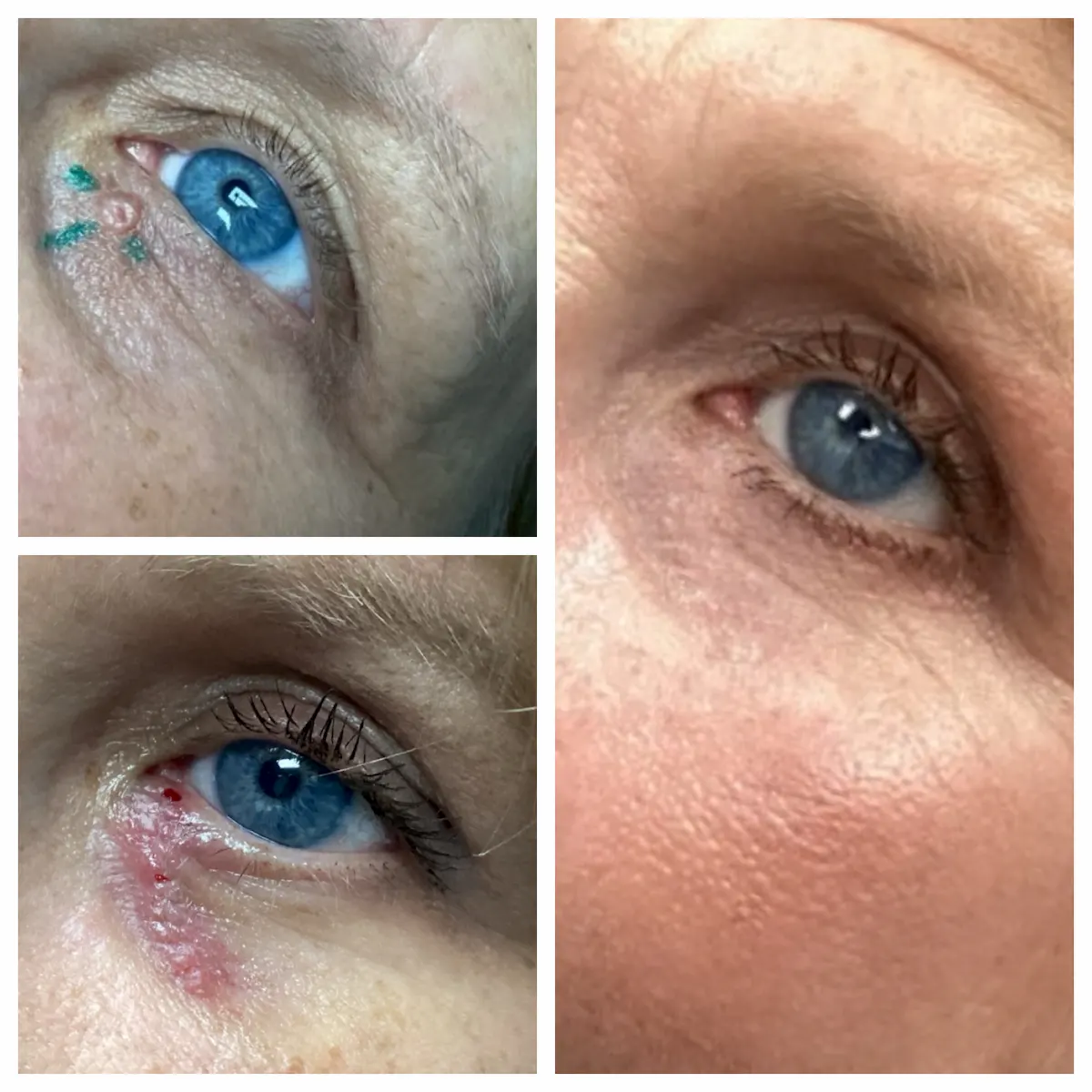 Mohs surgery and reconstruction on the lower eyelid, before and after — St. Louis Dermatology & Cosmetic Surgery