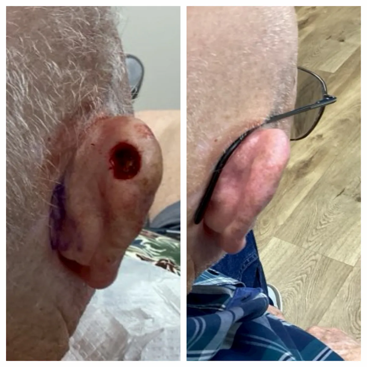 Right ear helix Mohs surgery and reconstruction, before and after — St. Louis Dermatology & Cosmetic Surgery