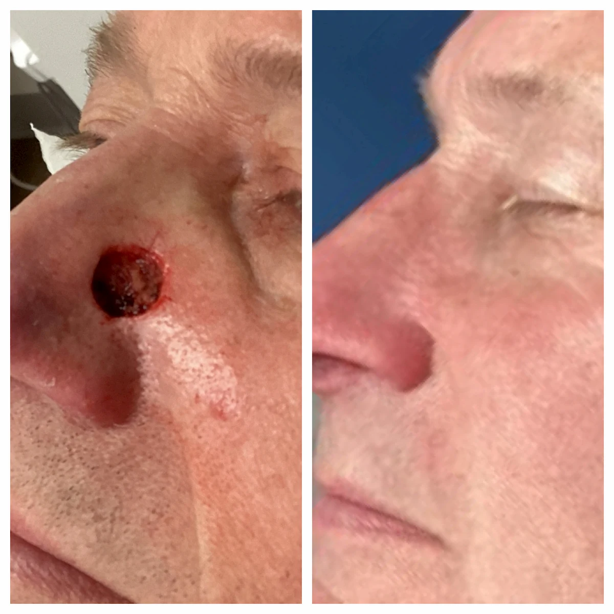 Nose basal cell carcinoma Mohs surgery and reconstruction, additional view — St. Louis Dermatology & Cosmetic Surgery