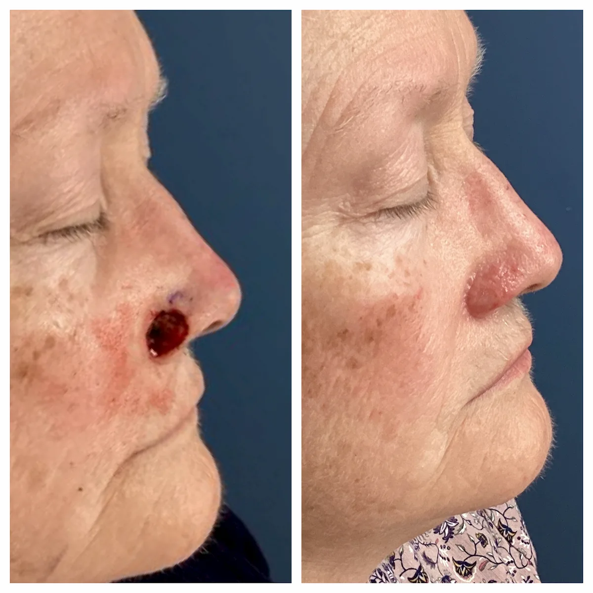 Nose basal cell carcinoma Mohs surgery and reconstruction, before and after — St. Louis Dermatology & Cosmetic Surgery