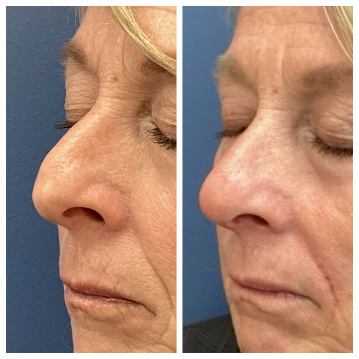 Non-surgical rhinoplasty with filler before and after, side view — St. Louis Dermatology & Cosmetic Surgery