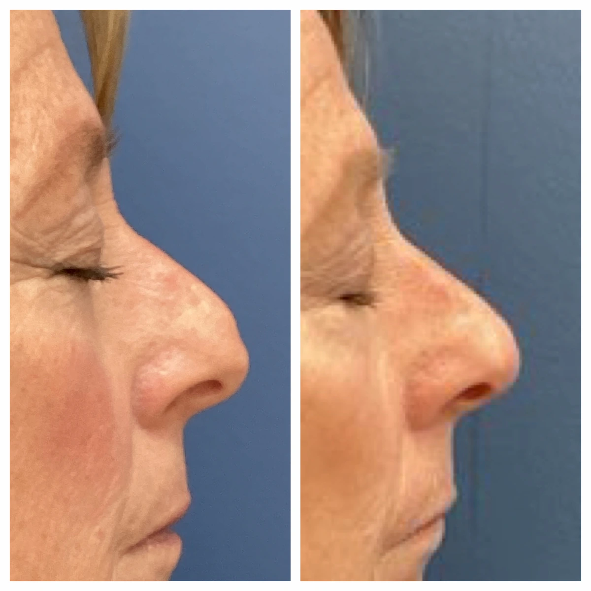 Non-surgical rhinoplasty with filler before and after, profile view — St. Louis Dermatology & Cosmetic Surgery