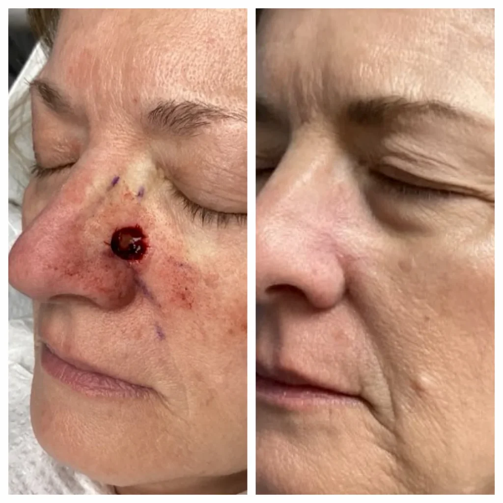 Nose Plastic Surgery