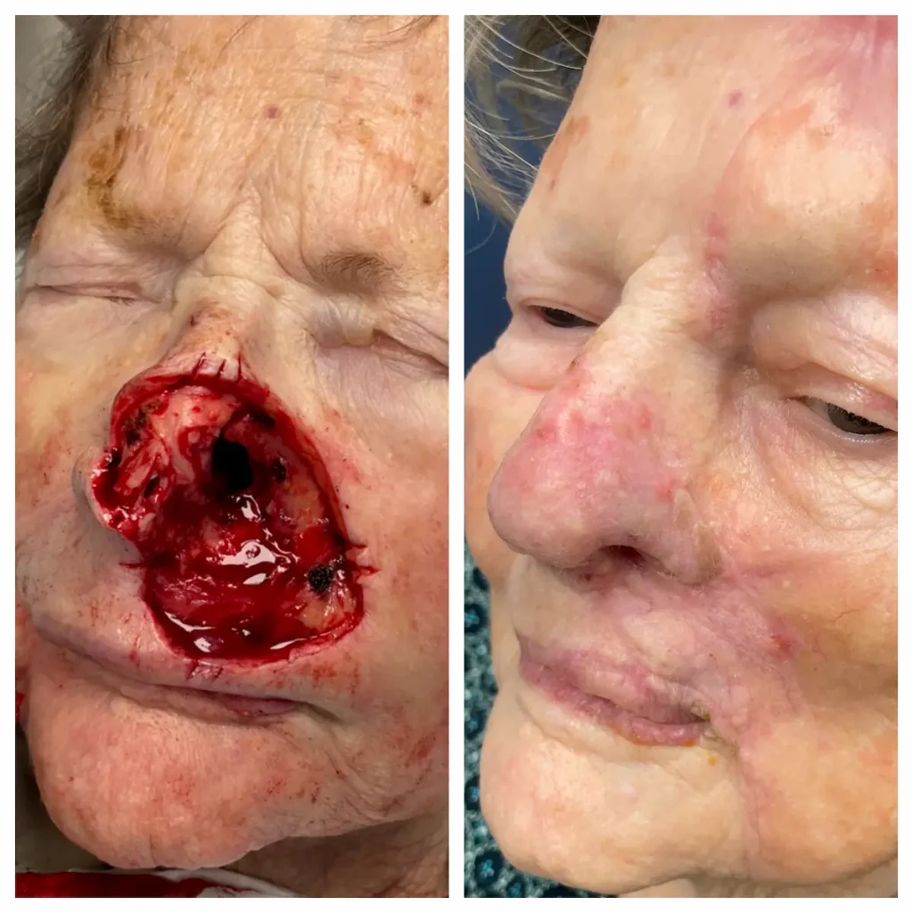 Nose Plastic Surgery after Mohs Surgery for Basal Cell Carcinoma