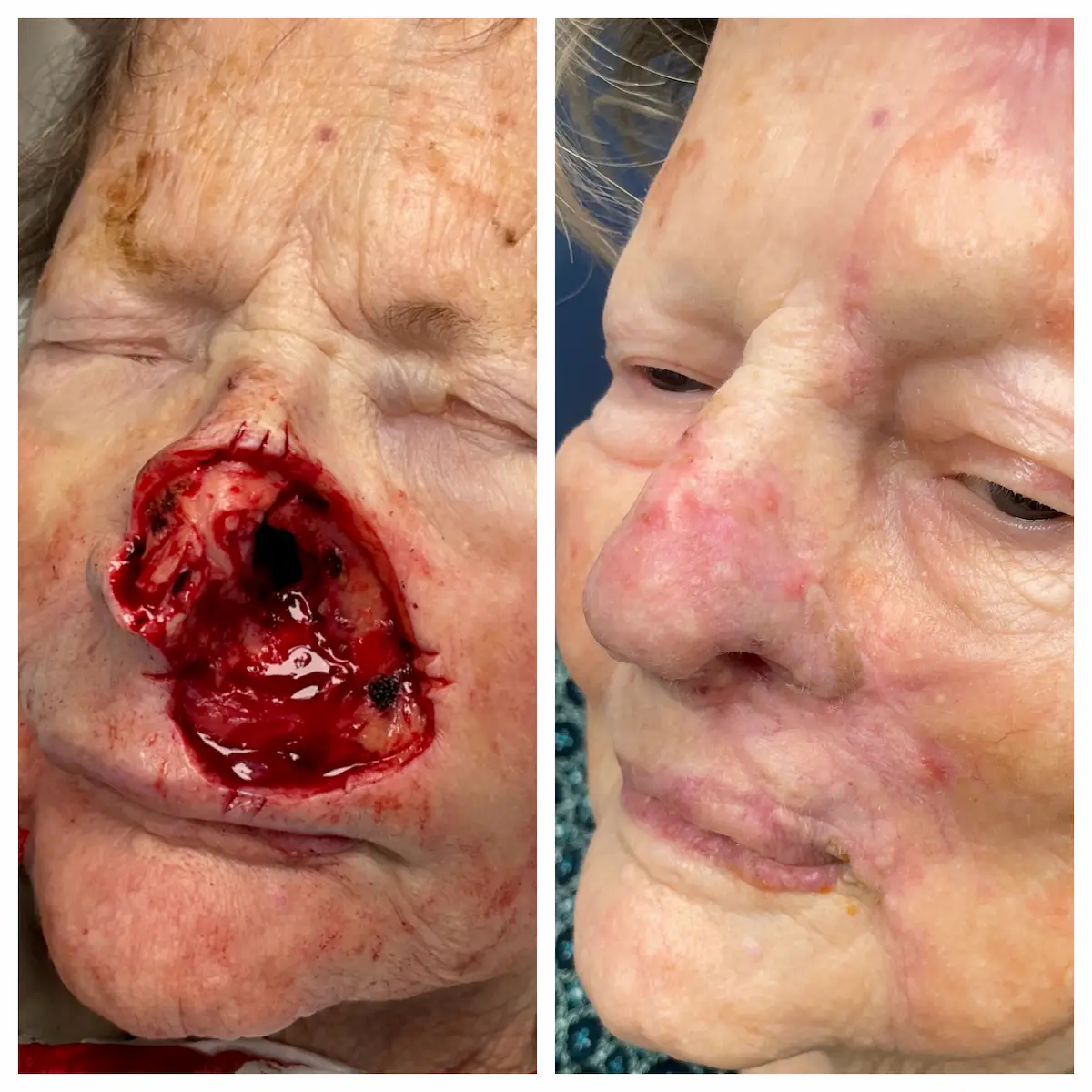 Nose basal cell carcinoma Mohs surgery and reconstruction, additional view — St. Louis Dermatology & Cosmetic Surgery