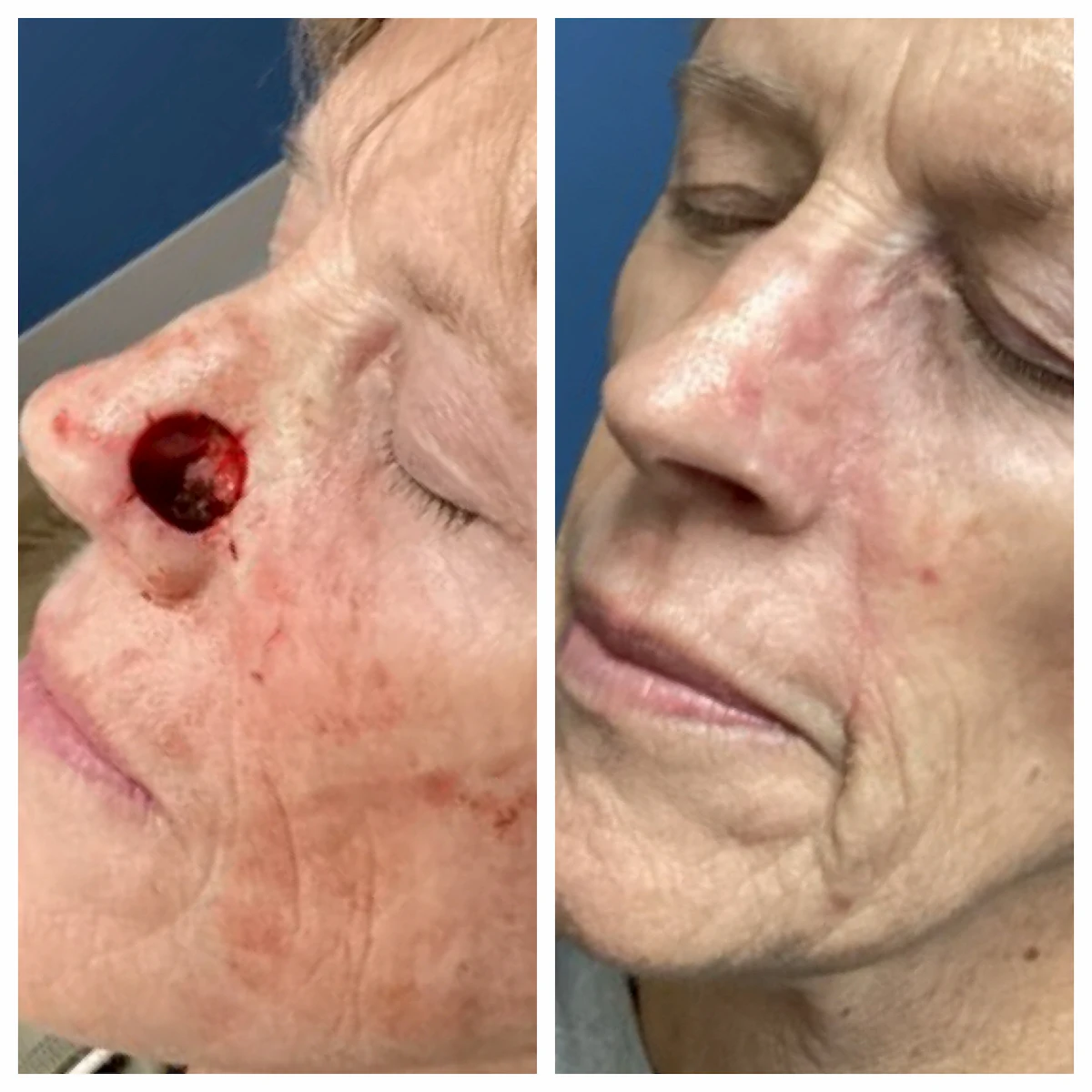 Nose Mohs surgery and reconstruction, additional view — St. Louis Dermatology & Cosmetic Surgery