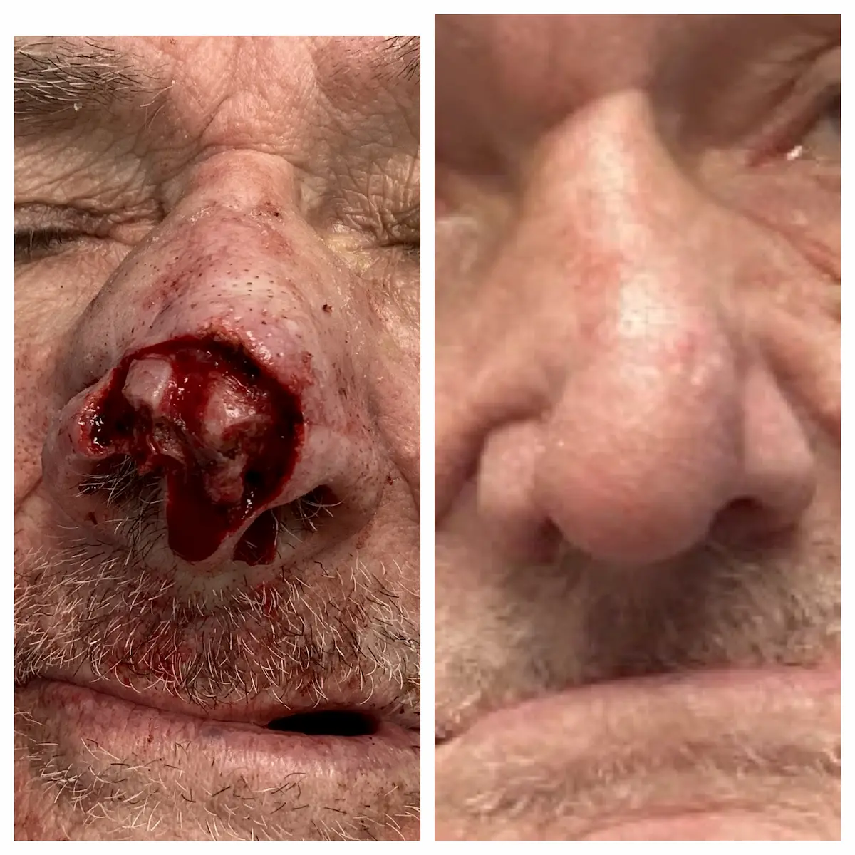 Forehead flap reconstruction after Mohs surgery, before and after — St. Louis Dermatology & Cosmetic Surgery