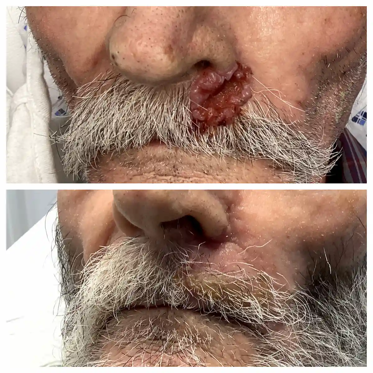 Lip Mohs surgery and reconstruction for skin cancer, before and after — St. Louis Dermatology & Cosmetic Surgery