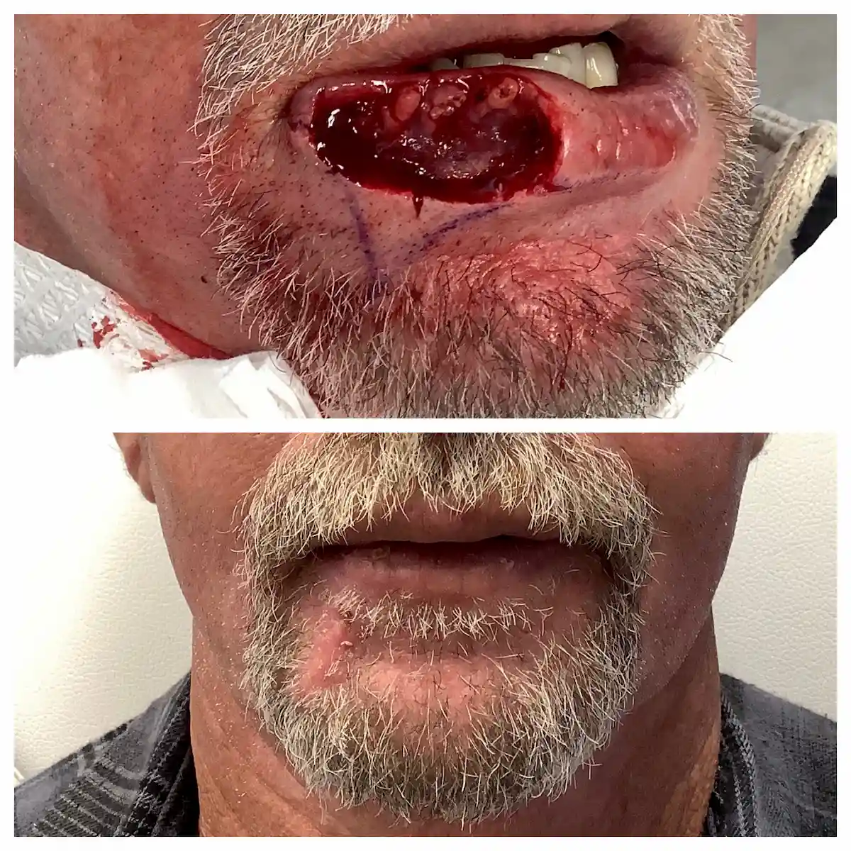 Lip Mohs surgery and reconstruction for skin cancer, before and after — St. Louis Dermatology & Cosmetic Surgery