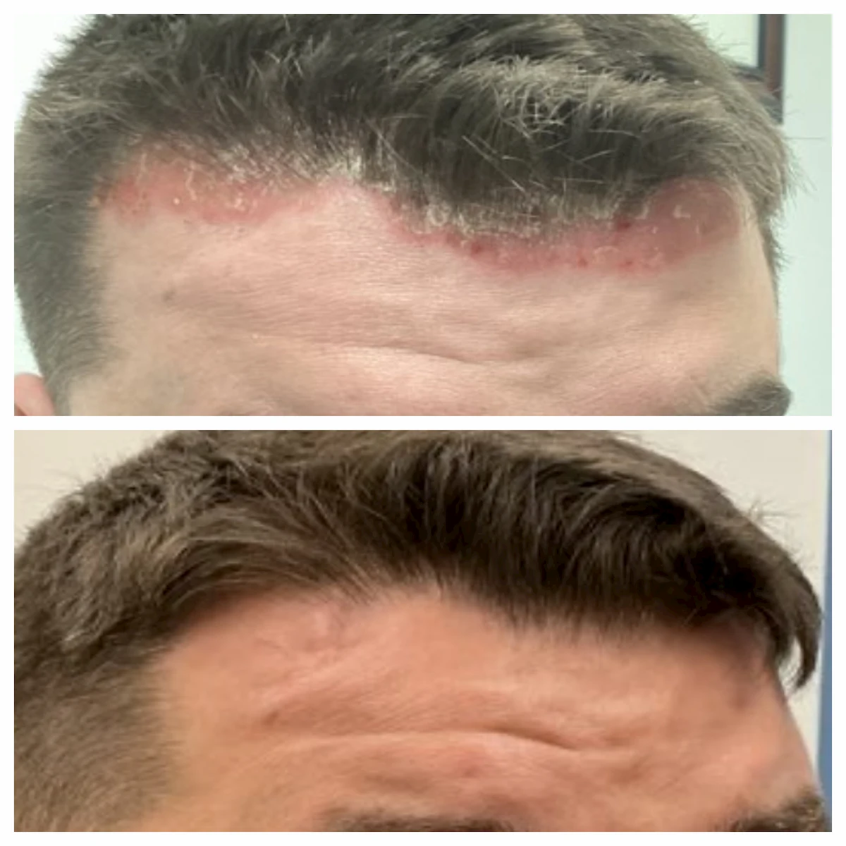 Scalp psoriasis before and after treatment — St. Louis Dermatology & Cosmetic Surgery