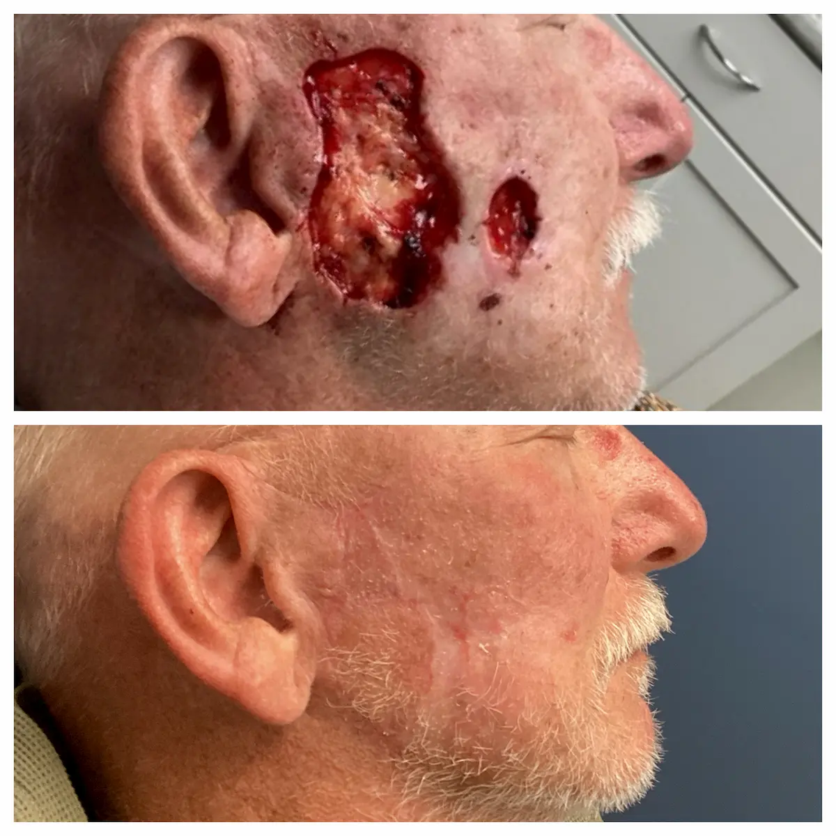 Recurrent cheek skin cancer Mohs surgery and reconstruction, before and after — St. Louis Dermatology & Cosmetic Surgery