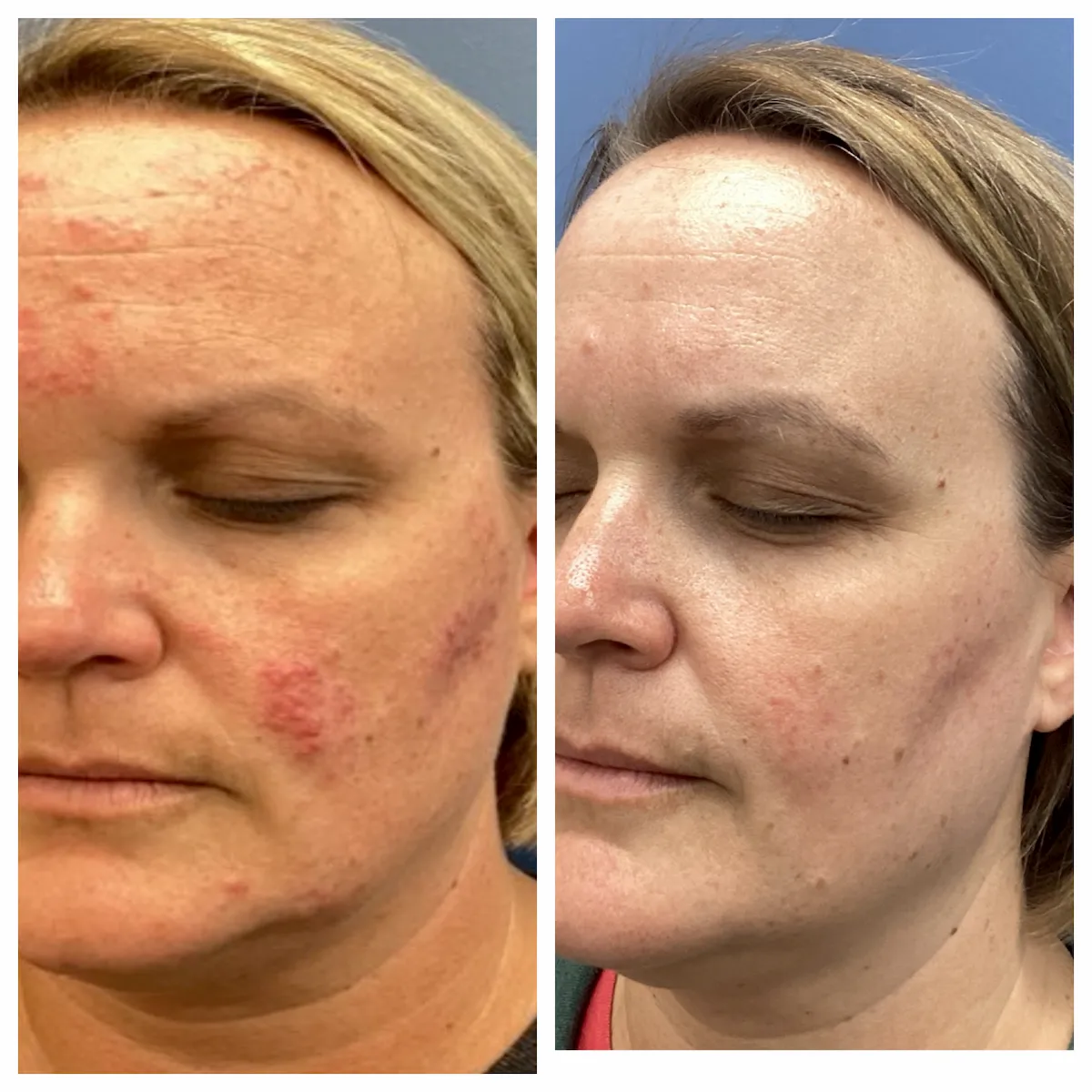 Rosacea facial redness before and after, cheek — St. Louis Dermatology & Cosmetic Surgery
