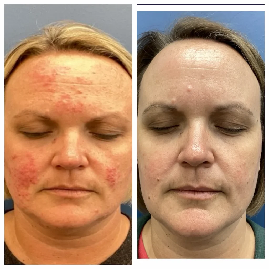 Rosacea Before and After Face