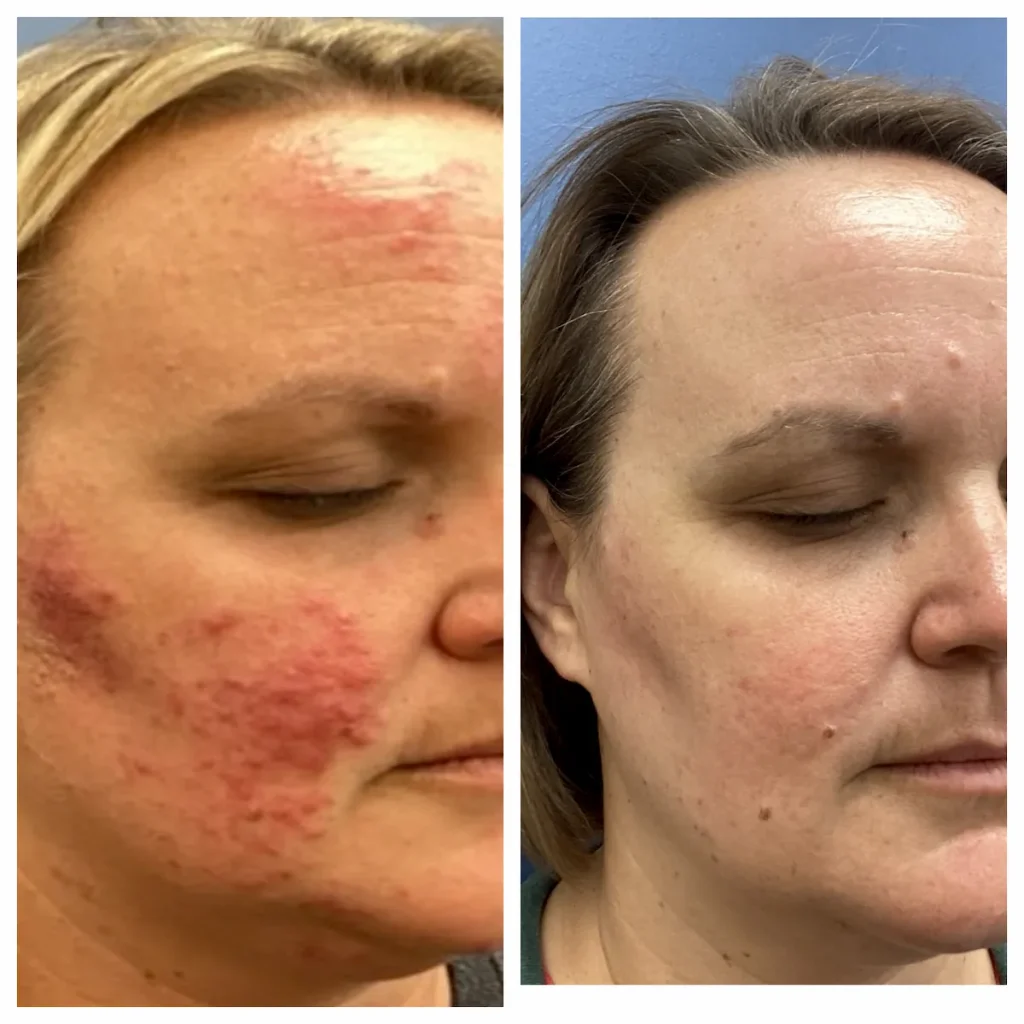 Rosacea Before and After Face 2