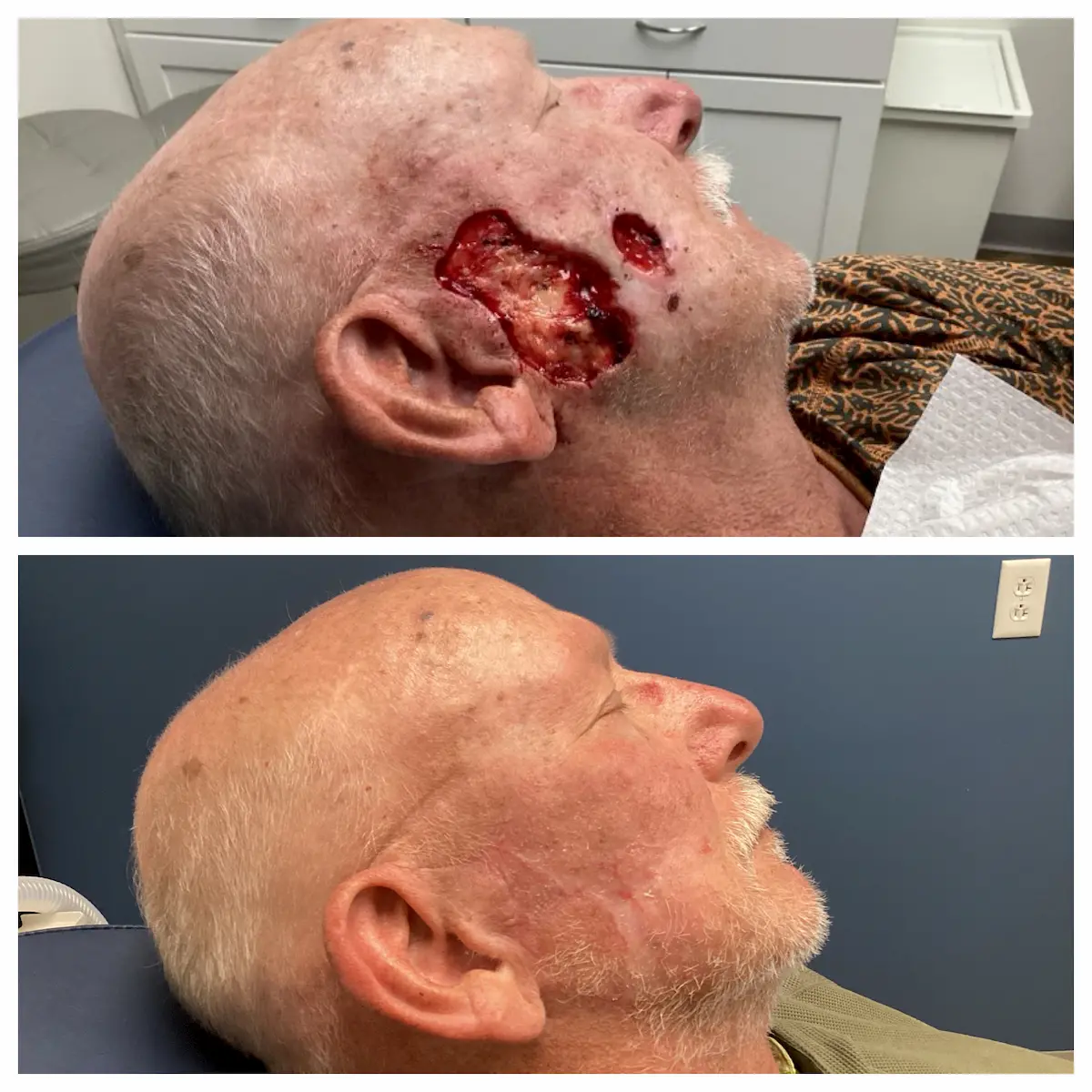 Severe cheek skin cancer Mohs surgery and reconstruction, before and after — St. Louis Dermatology & Cosmetic Surgery