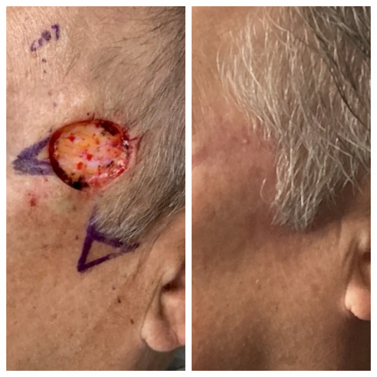 Temple Mohs surgery and reconstruction, before and after — St. Louis Dermatology & Cosmetic Surgery