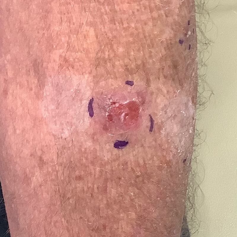 basal-cell-skin-cancer