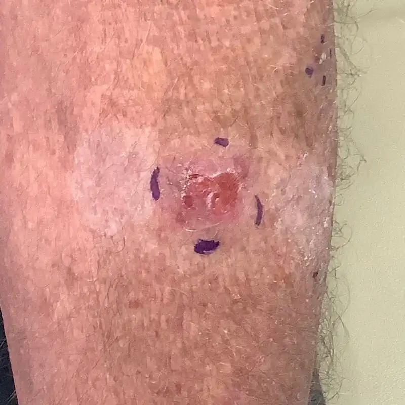 basal-cell-skin-cancer
