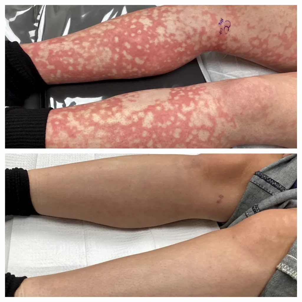 before and after leg rash copy