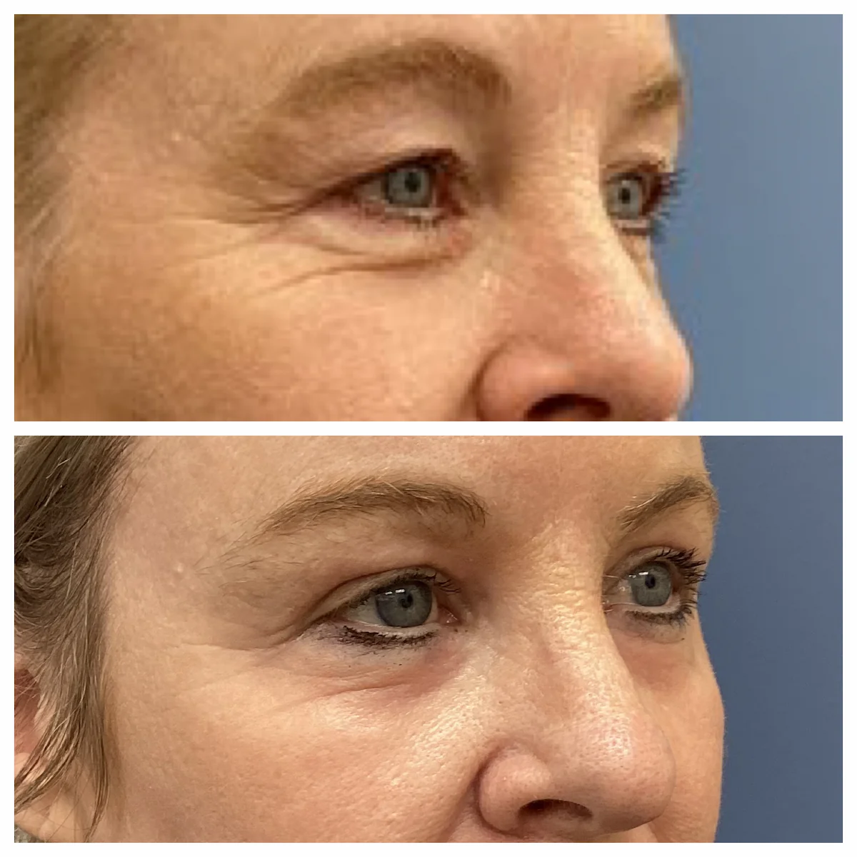 Eyelid lift with CO2 laser before and after, view one — St. Louis Dermatology & Cosmetic Surgery