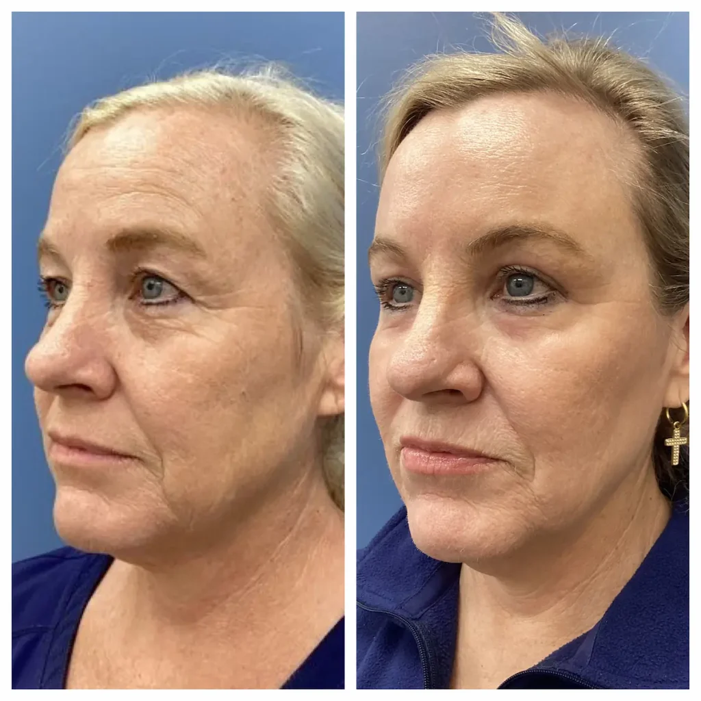 blepharoplasty_eyelid_lift_co2-x1 (3)