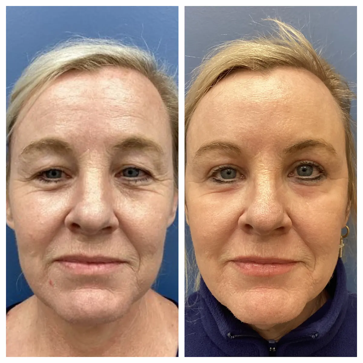 Eyelid lift with CO2 laser before and after, view six — St. Louis Dermatology & Cosmetic Surgery