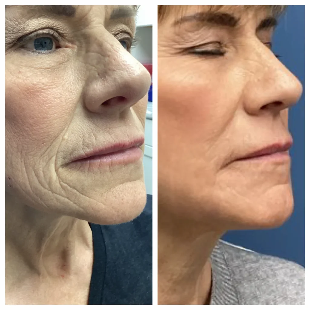 c02-laser-resurfacing-st-louis (1)