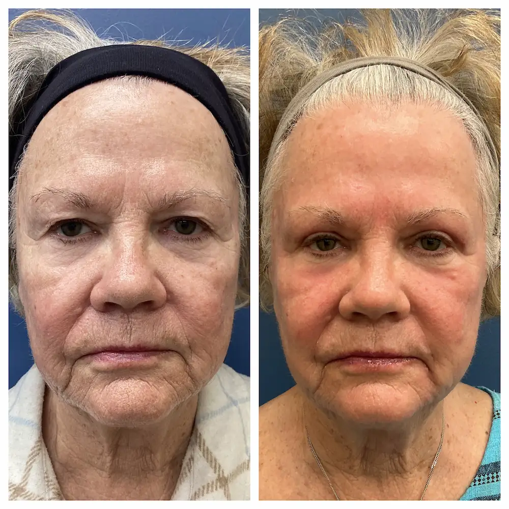 CO2 laser full-face resurfacing before and after, patient of Dr. Brandon T. Beal