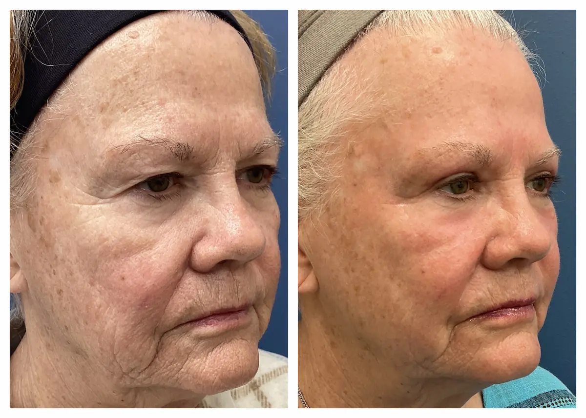 Full-face CO2 laser resurfacing before and after, opposite oblique view — St. Louis Dermatology & Cosmetic Surgery